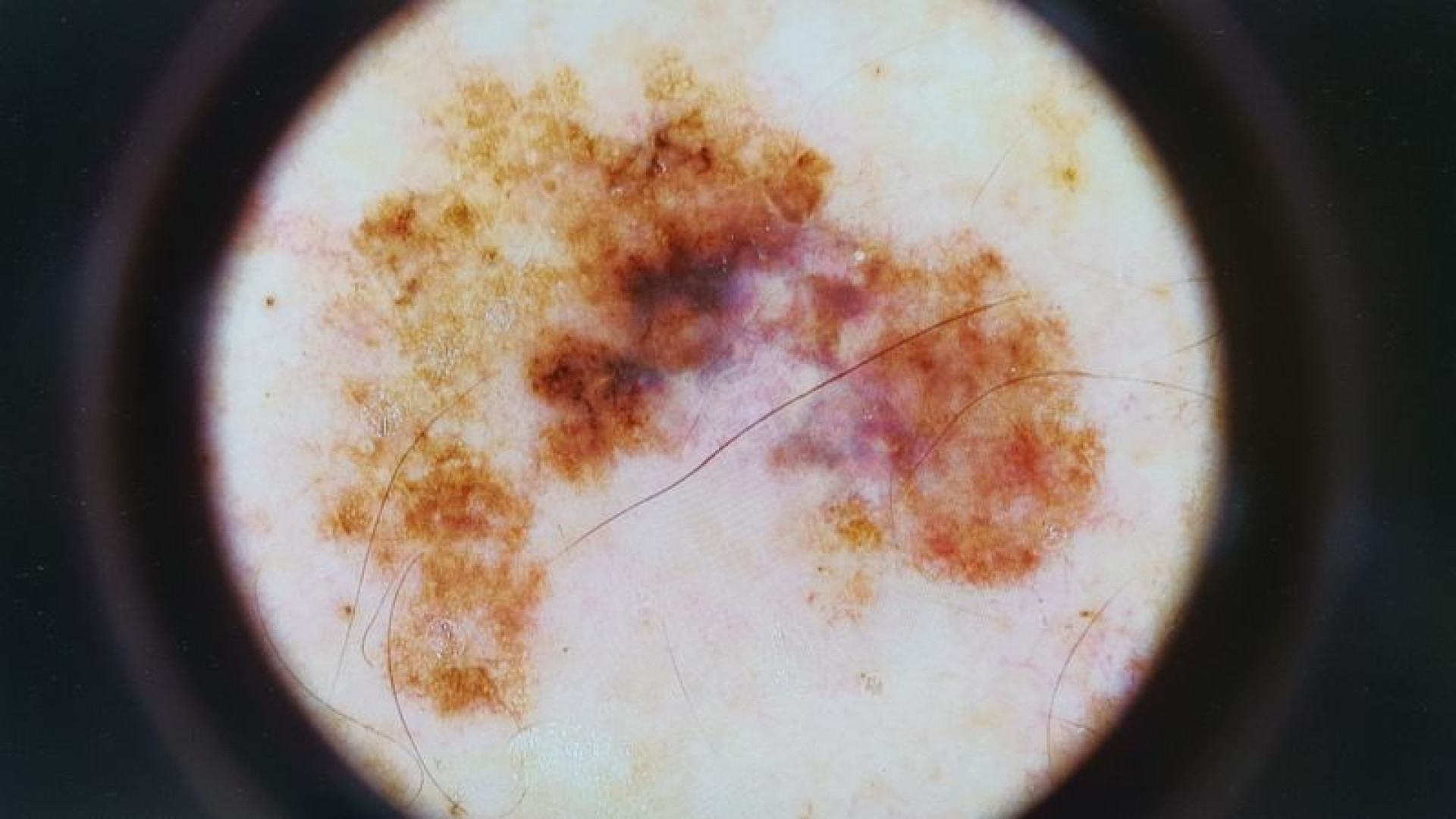 Esposizione solare: 90 melanomi asportati nel 2022. Ecco come evitare i rischi