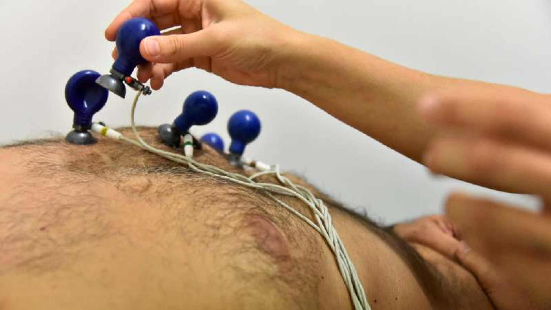 Infarti acuti: 180 casi all'anno, mortalità extra ospedaliera del 40%. Ausl: "Chiamate il 118"